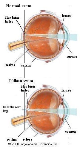 hyperopia plusz 1 mely vitamin befolyásolja a látást