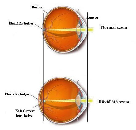 rövidlátó szem javítása